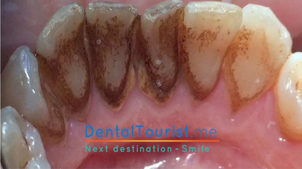 dent-5.1.jpg